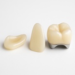Composite Fused to Metal Crown