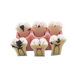 Removable Caries Model Dental Typodont for Training and Demonstration