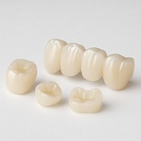 e.max ( post, inlay)