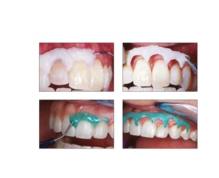 OpalDam Light-Curing Resin Gingival Protector Kit
