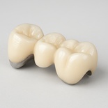 PFM CoCr Crown/Bridge (3D print metal coping)